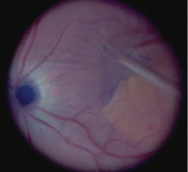 Limited Or Complete Vitrectomy For ERM Retina Today